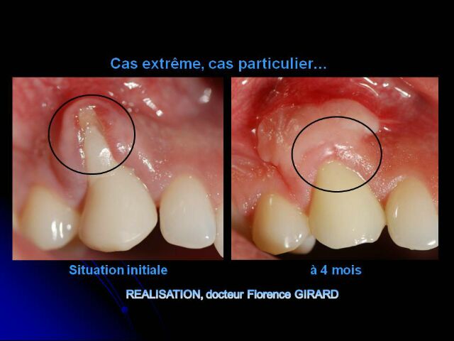 cas-2-Chirurgie muco-gingivale